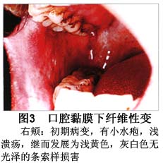 口腔黏膜下纤维化_口腔黏膜下纤维化的病因病机,临床表现,诊断,治疗_