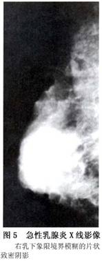 急性乳腺炎X線影像