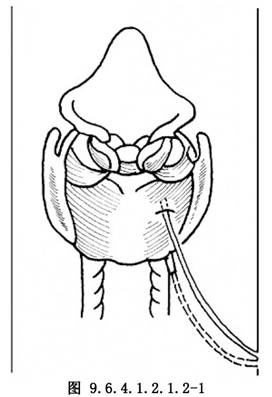 喉返神经植入环杓后肌术