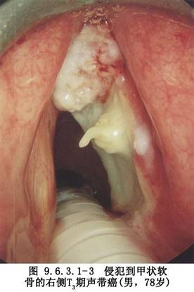 声门上癌  ①t3～t4;②声带已固定;③会厌室带癌并侵犯声带;④侵犯