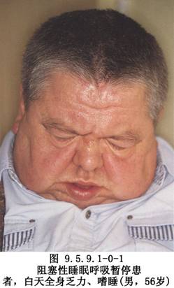 悬雍垂-腭-咽成形术_手术_医学百科