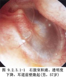 1.鼓室积液,由于咽鼓管功能障碍或前,后峡阻塞,鼓室呈负压者(图9.2.3.