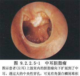 乳突根治术_手术,急性中耳炎和慢性中耳炎手术,中耳手术,耳鼻喉科手术
