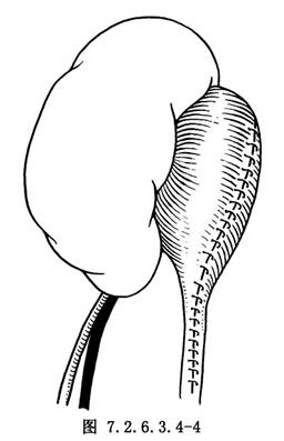 螺旋形长舌状肾盂壁瓣肾盂成形术