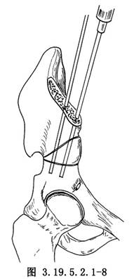 salter无名切骨术 词条正文用两把巾钳分别夹住截骨后的髂骨上,下两个