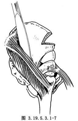 pemberton髋臼成形术_先天性髋关节脱位的手术治疗,手术,髋臼成形术及