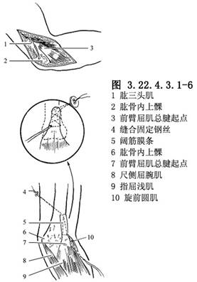 如尺神经紧张,可移位至肘前.逐层缝合切口.