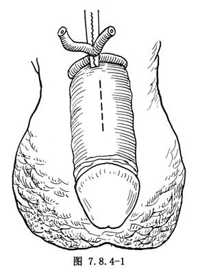 切除阴茎硬结 用组织钳固定并提起纤维瘢痕体,沿瘢块边缘切开阴茎筋膜