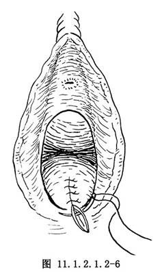 陈旧性会阴二度裂伤修补术