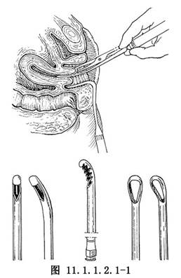 安放窥器,暴露宫颈,消毒阴道及宫颈,用宫颈钳钳夹前唇,向外牵拉,使