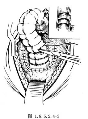 直肠前壁折叠术