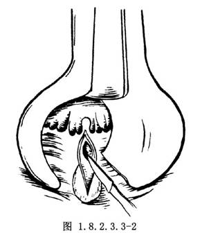 内括约肌切断术