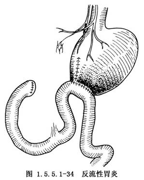 billrothi式胃次全切除术