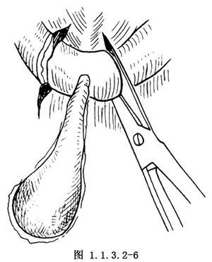 甲状舌管囊肿和甲状舌管窦道切除术_手术,颈部囊肿,瘘管手术,普通外科