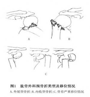 肱骨外科颈骨折_肱骨外科颈骨折的病因病机,临床表现,症状,诊断,中医