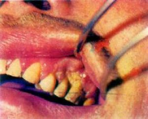 口腔良性肿瘤图片