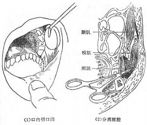 颊间隙蜂窝织炎_颊间隙蜂窝织炎的病因病机,临床表现,诊断,治疗_医学