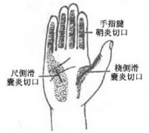 手掌深部间隙感染