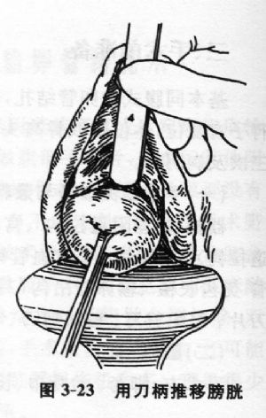 阴道式输卵管结扎术