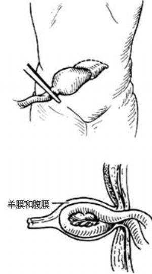 脐疝修复术_注解,脐疝修复术是什么,手术_医学百科