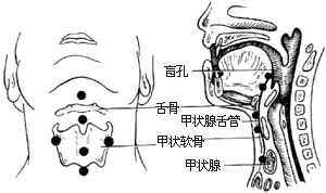 甲状腺舌管囊肿(瘘)切除术