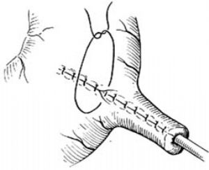 瓣⑵缝合胃壁切口⑶制成"胃管"⑷引出胃管图管式胃造瘘术(janeway)