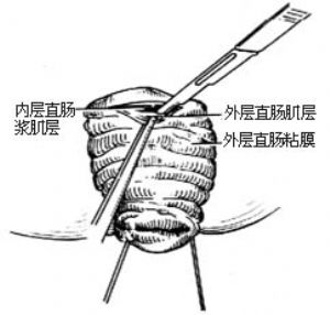 直肠脱垂经会阴切除术