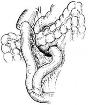胆肠吻合术示意图图片