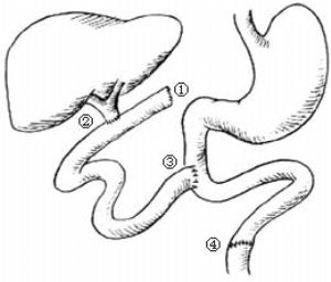间置空肠胆管十二指肠吻合术2010年01月13日修订版_医学百科