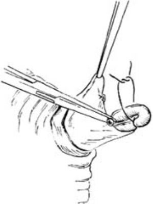 输精管结扎术2010年01月13日修订版_医学百科