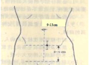 腹膜透析導管植入點定位