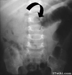 肠套叠_肠套叠的病因病机,临床表现,诊断,治疗_医学百科