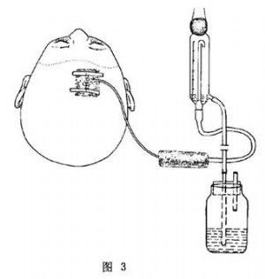 侧脑室穿刺和引流术