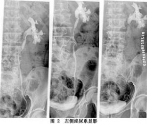 逆行性肾盂造影