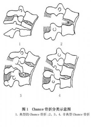 chance骨折_chance骨折的病因病机,临床表现,诊断,治疗_医学百科