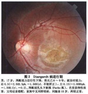 5pd,呈如同被锤击过的青铜片样外观(beaten bronze atrophic area)