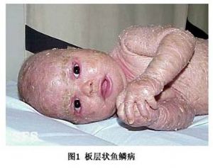 片層狀魚鱗癬 片層狀魚鱗癬的病因病機 臨牀表現 診斷 治療 醫學百科 片層狀魚鱗癬 片層狀魚鱗癬的病因病機 臨牀表現 診斷 治療 醫學百科