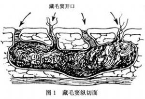 窦道内含毛发,有时毛发在窦道口伸出(图1).