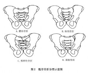 7骶骨骨折分型波及第1,2骶椎的骨折,可出现类似坐骨神经痛的症状(骶1