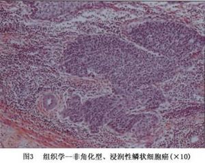 图3 组织学-非角化型，浸润性鳞状细胞癌