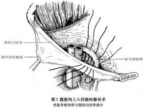 股疝_股疝的病因病机,临床表现,症状,诊断,治疗_医学百科