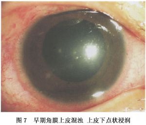 早期角膜上皮溼濁 上皮下點狀浸潤