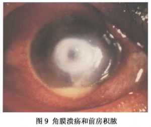 角膜潰瘍和前房積膿