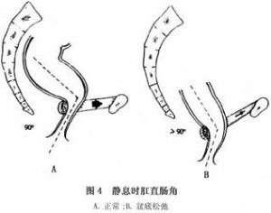 会阴下降综合征 词条正文的排粪造影诊断标准有:①以肌压迹中点代表