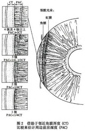 睫状环阻滞性青光眼