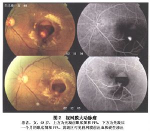 视网膜大动脉瘤