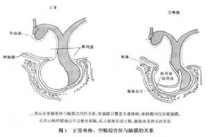 鞍膈缺损_鞍膈缺损的病因病机、临床表现、症状、诊断、治疗_医学百科