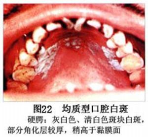 口腔白斑症
