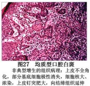 口腔白斑症