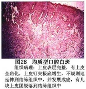 口腔白斑症